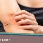 Kaşıyınca Kaşıntı Hissi Neden Gider ?